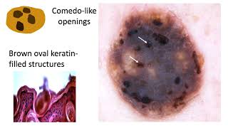 Seborrheic keratosis and solar lentigo  Dr Cristian NAVARRETEDECHENT [upl. by Stephens251]