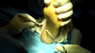 Plantar Fasciotomy [upl. by Dlarrej594]