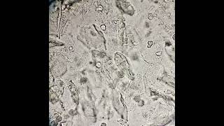 فحص الادرار العام urinalysis urineexamination GUE epithelial cells pus cells Bacteria [upl. by Lashondra132]