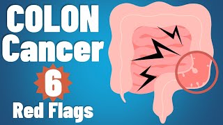 Colon cancer 6 EARLY symptoms amp why they occur  Colon cancer symptoms  colorectal cancer [upl. by Eniamrehs986]