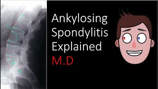 Ankylosing Spondylitis Explained [upl. by Eralc176]