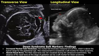 Down Syndrome Soft Markers Fetal Ultrasound Report Example  Trisomy 21 Aneuploidy Obstetric USG [upl. by Brana]