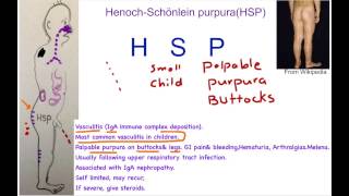 HenochSchönlein Purpura Mnemonic [upl. by Einohpets598]