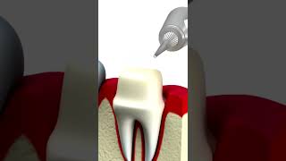 Dental Crown Timeline What to Expect [upl. by Roma254]