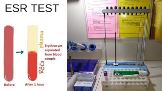 Esr Test ProcedureEsr Test by Westergren MethodEsr TestAdnanMLT [upl. by Trude527]