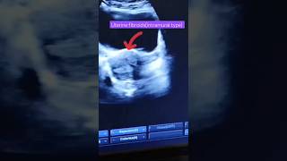 Uterine fibroidsultrasound imagesfibroidsintramural typeytshortshortvideo [upl. by Yorle382]