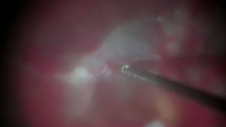 Vitrectomy in a case of PDR [upl. by Enorel]