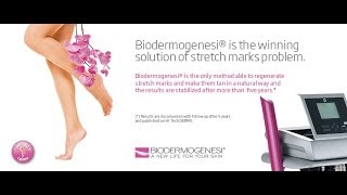 Biodermogenesi solution to stretch marks follow up after 5 years [upl. by Secundas]