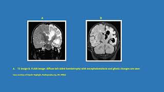 Neurology Quiz 80 Rasmussens encephalitis [upl. by Yorgo986]