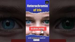 heterochromia of iris  Different Colored Eyes heterochromia eyes ophthalmology testpaperlive [upl. by Aaronson]