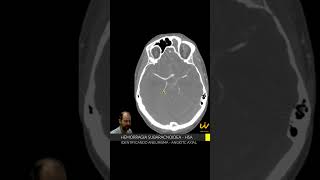 ANEURISMA CEREBRAL na AngioTC de Crânio  HSA [upl. by Raney]