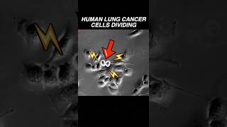 Human lung cancer cells dividing RAPIDLY microscope cancer biology oncology medical science [upl. by Love]