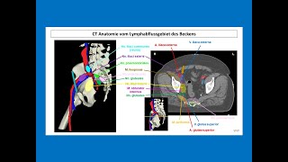 CT Anatomie vom Lymphabfluss des Beckens  Strahlentherapie Prof Hilke Vorwerk [upl. by Notterb]