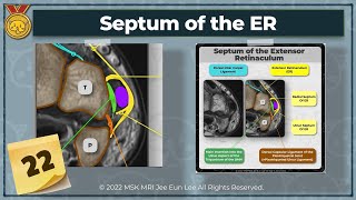 KOR Anatomy22 Septum of the Extensor Retinaculum wrist MRI [upl. by Imuyam]