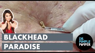 Blackhead Paradise [upl. by Fast]