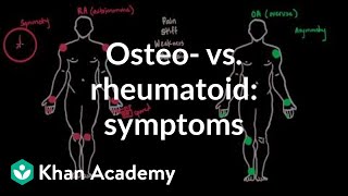 Osteoarthritis vs rheumatoid arthritis symptoms  NCLEXRN  Khan Academy [upl. by Paris]