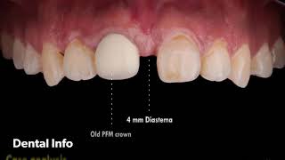 Management Of Large Diastema [upl. by Pall]