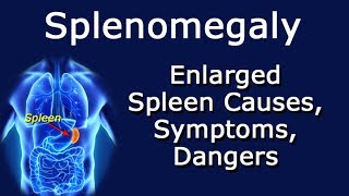 Splenomegaly Enlarged Spleen Causes Symptoms Dangers [upl. by Statis]