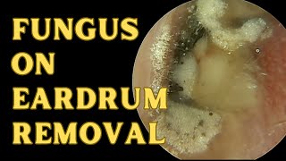 Aspergillus Niger Sits On Eardrum [upl. by Elery]