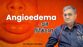 Angioedema  What is Angioedema in Bengali  এনজিওইডিমা কি  Dr Naren Pandey [upl. by Tung]