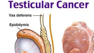 Testicular Cancer symptoms treatment management  Medical Surgical Nursing NCLEXRN REVISION [upl. by Naerad]