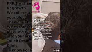 PRP Treatment for Hair Regrowth hair lossat Touch Derma Clinic us80778432577840050530 [upl. by Vincelette]