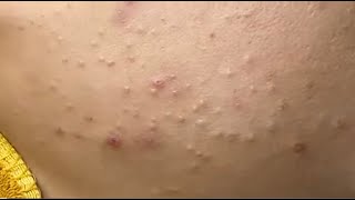 Remove hidden acne on the jaw Nở P1 HoangMySpa55 [upl. by Nodnerb]