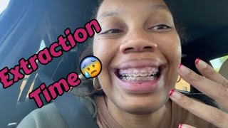 Dentist Vlog 4  Is it worth it Tooth Extraction Finally [upl. by Sellig]