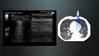 Pulmonary Ultrasound in Dyspnea [upl. by Cesya]