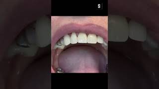 Коронки или Виниры Crowns vs Veneers smile dentalintes medical dental [upl. by Calloway]