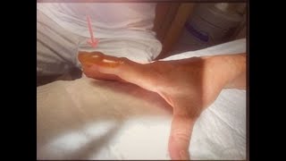 Paronychia Abscess Drainage A didactic video for young surgeons [upl. by Nelleoj239]