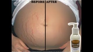 Stretch Mark Cream Before and After Product Reviews [upl. by Atreb]