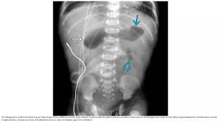 Duodenal Atresia or Stenosis Imaging [upl. by Sheaff]