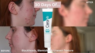 30 DAYS OF Cerave Blemish Control Gel for Blemishes Blackheads and Uneven Texture One Month Review [upl. by Edniya]