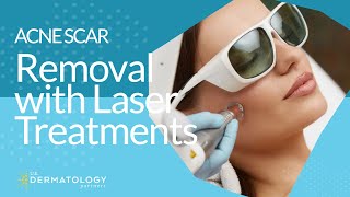 Acne Scar Removal with Laser Treatments [upl. by Deirdra]