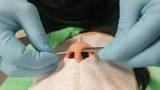 PERFORACIÓN SEPTUM EN NARIZ CON TABIQUE NASAL DESVIADO [upl. by Mahmud]