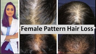 Hair loss in women  Female Pattern Hair Loss  causes amp treatment  Dermatologist [upl. by Aitital]