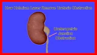 Obstruction Removal at the Ureteropelvic Junction UPJ through Holmium Laser [upl. by Isdnyl]