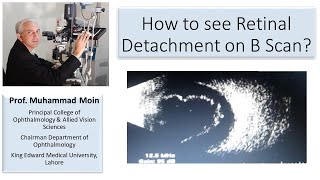 How to see Retinal Detachment on B Scan [upl. by Erb141]