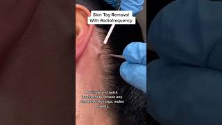 Skin Tag Removal With Radiofrequency  Quick amp Safe Treatment DRMEDISPA [upl. by Neelrihs]