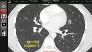 Lobar and Segmental Lung Anatomy on CT [upl. by Aneg335]