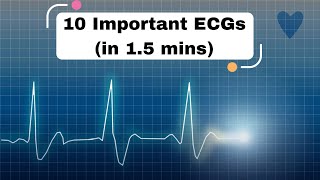 10 Important ECGs in 15 mins cardiology ecg ekg [upl. by Anirrak]