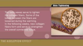 Skin tightening with radiofrequency of Effect systems by Asclepion [upl. by Dinse222]