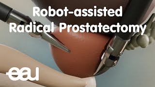 Robotassisted Radical Prostatectomy RARP [upl. by Charlene]