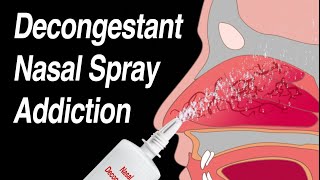 How to use Nasal Spray CORRECTLY  Nasal Steroids [upl. by Swigart402]