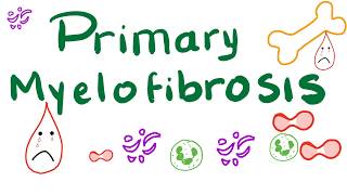 Primary Myelofibrosis PMF  Myeloproliferative Neoplasm Bone Marrow Fibrosis [upl. by Kenway651]