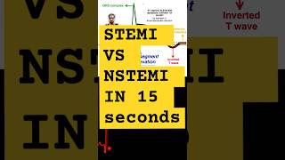 STEMI vs NSTEMiecg ST segment elevation vs ST segment depression stemi  cathlab [upl. by Jasun751]