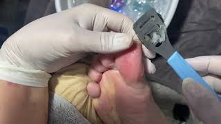 Callus removal oddly satisfying video [upl. by Dnaltroc]