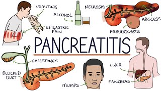 Understanding Pancreatitis [upl. by Bobine]