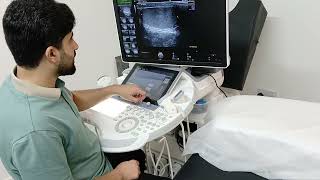 Scrotal Ultrasound  Hydrocele  microlithiasis [upl. by Tifanie657]